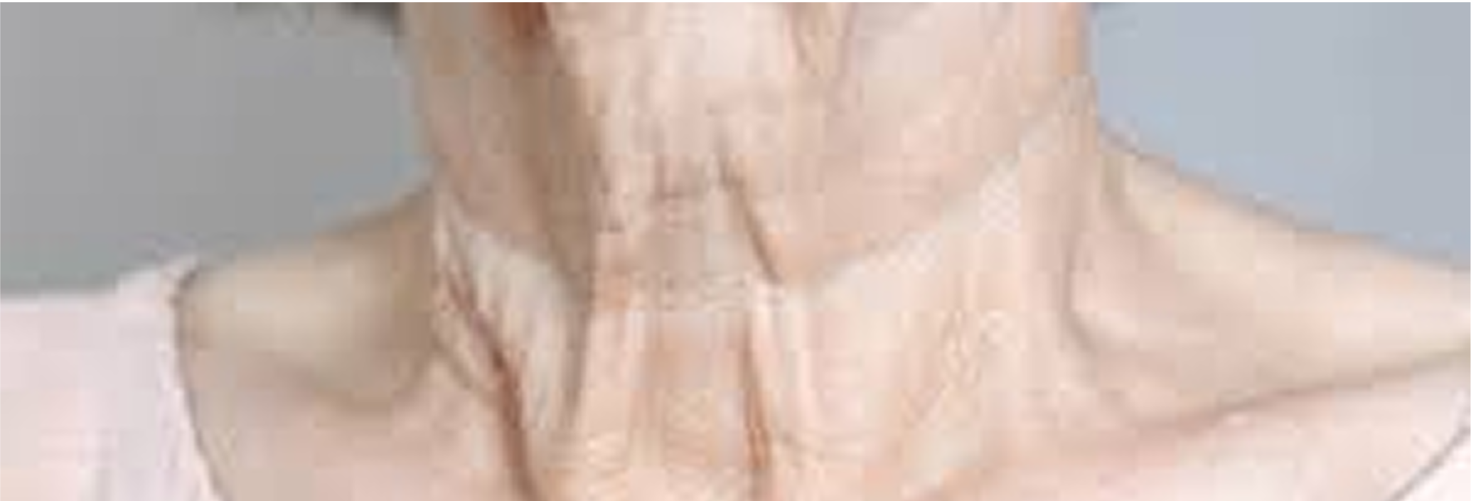 Deep neck creases