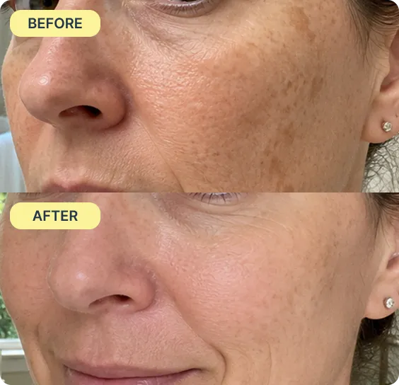Before during and after acne results