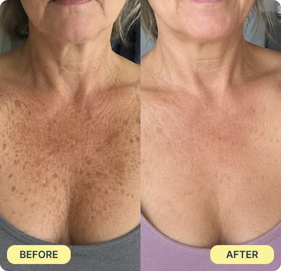 Before during and after acne results