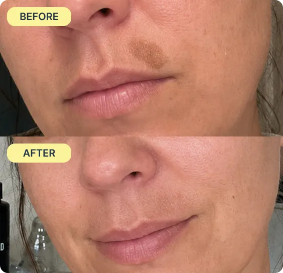 Before during and after acne results