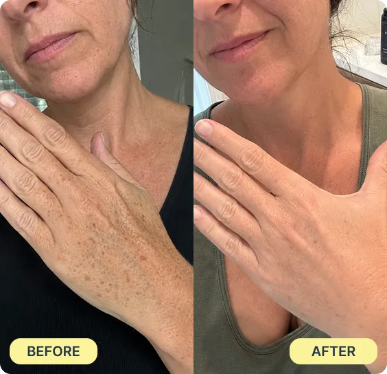 Before during and after acne results