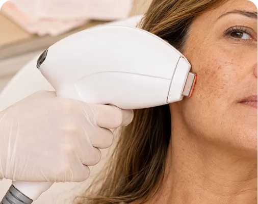 IPL skin treatment