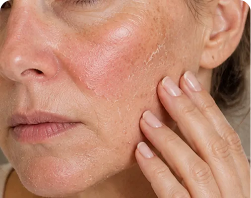 Skin reacting to a chemical peel