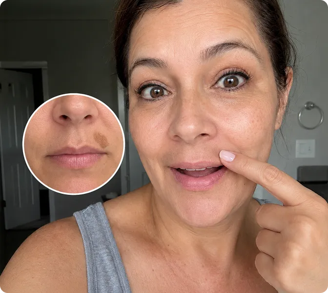 Brenda showing her fading upper-lip spot