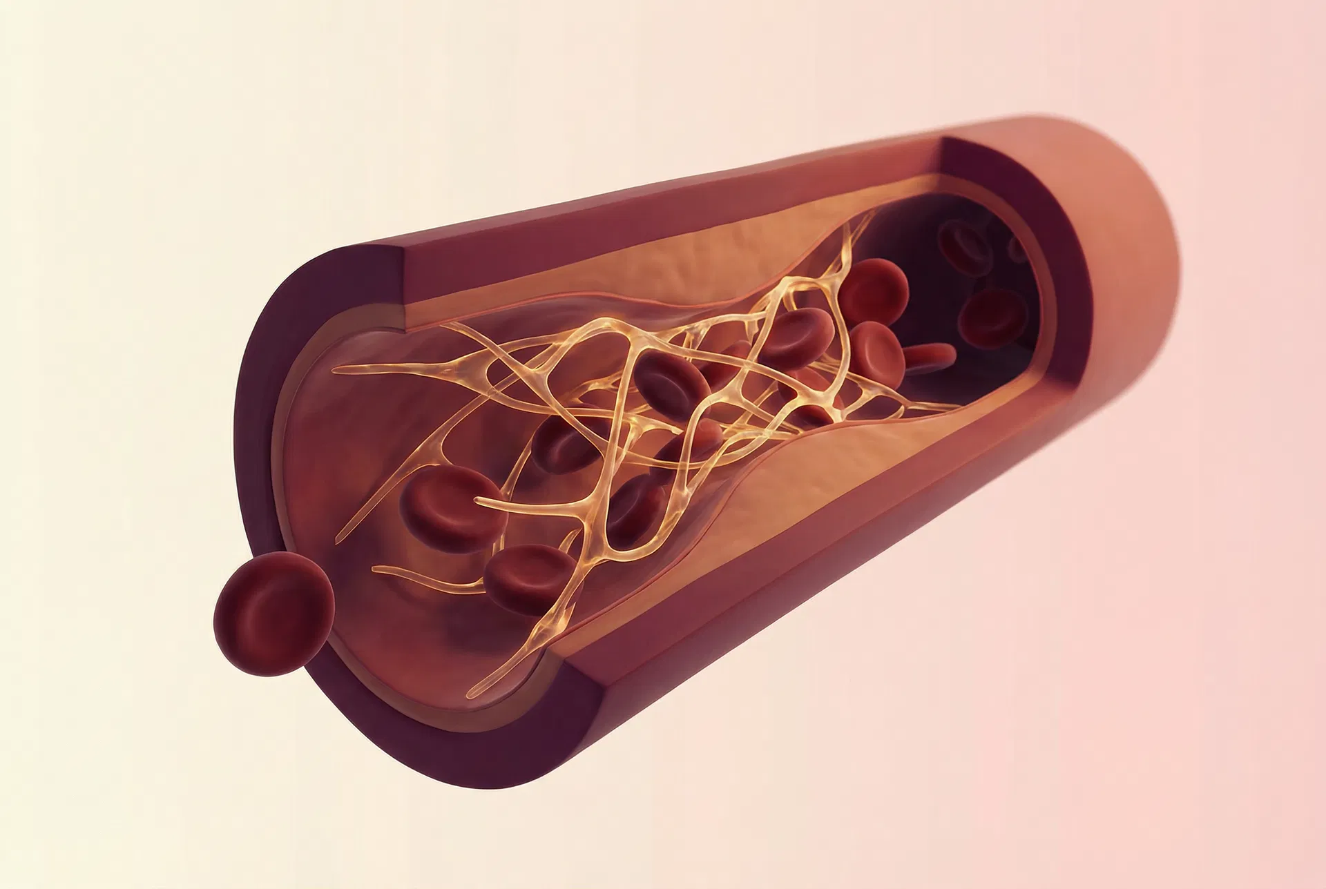Poor circulation and fibrin buildup illustration