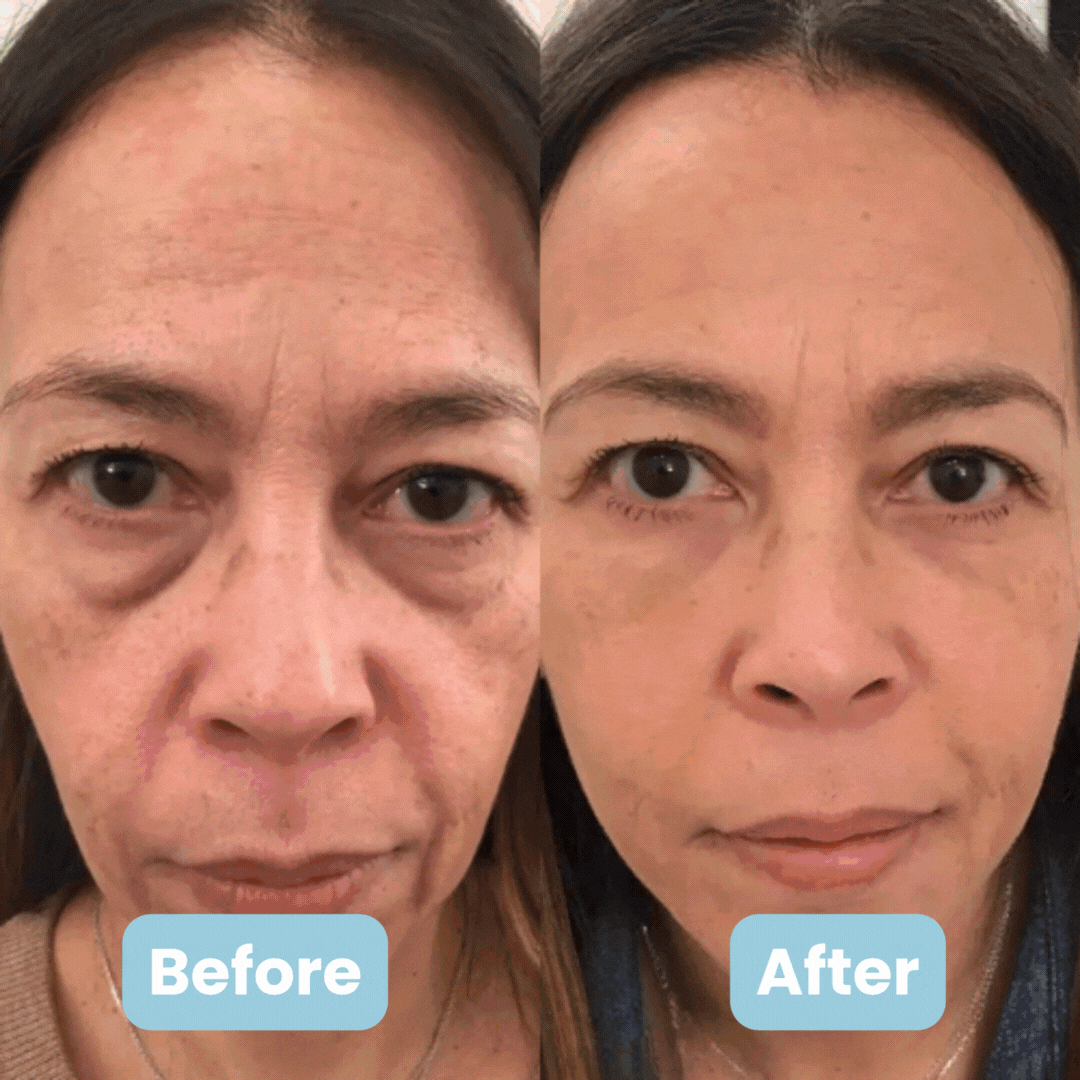 Side-by-side comparison of a woman's face labeled 'Before' and 'After'.