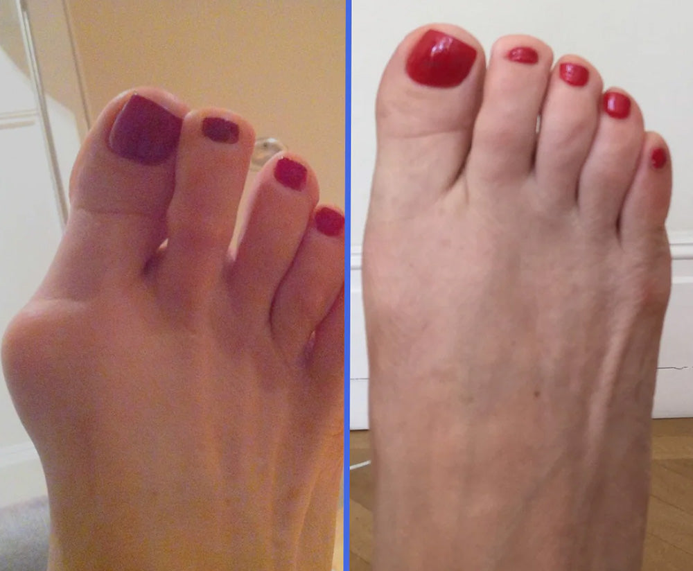 Vorher-Nachher Ballenzeh