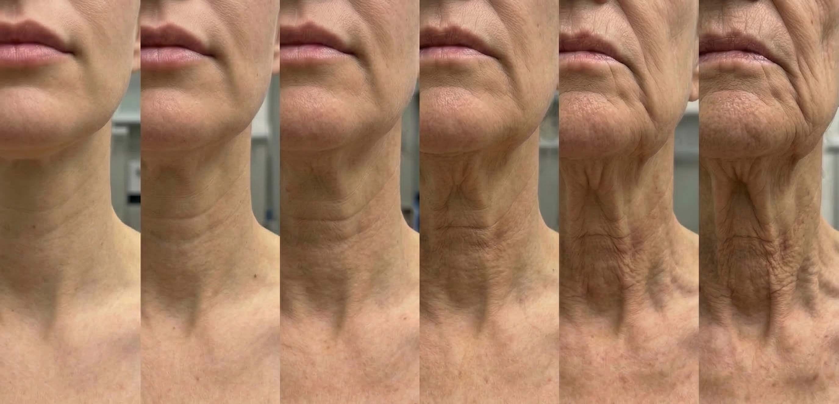 Illustration des fortschreitenden Alterungsprozesses am Hals