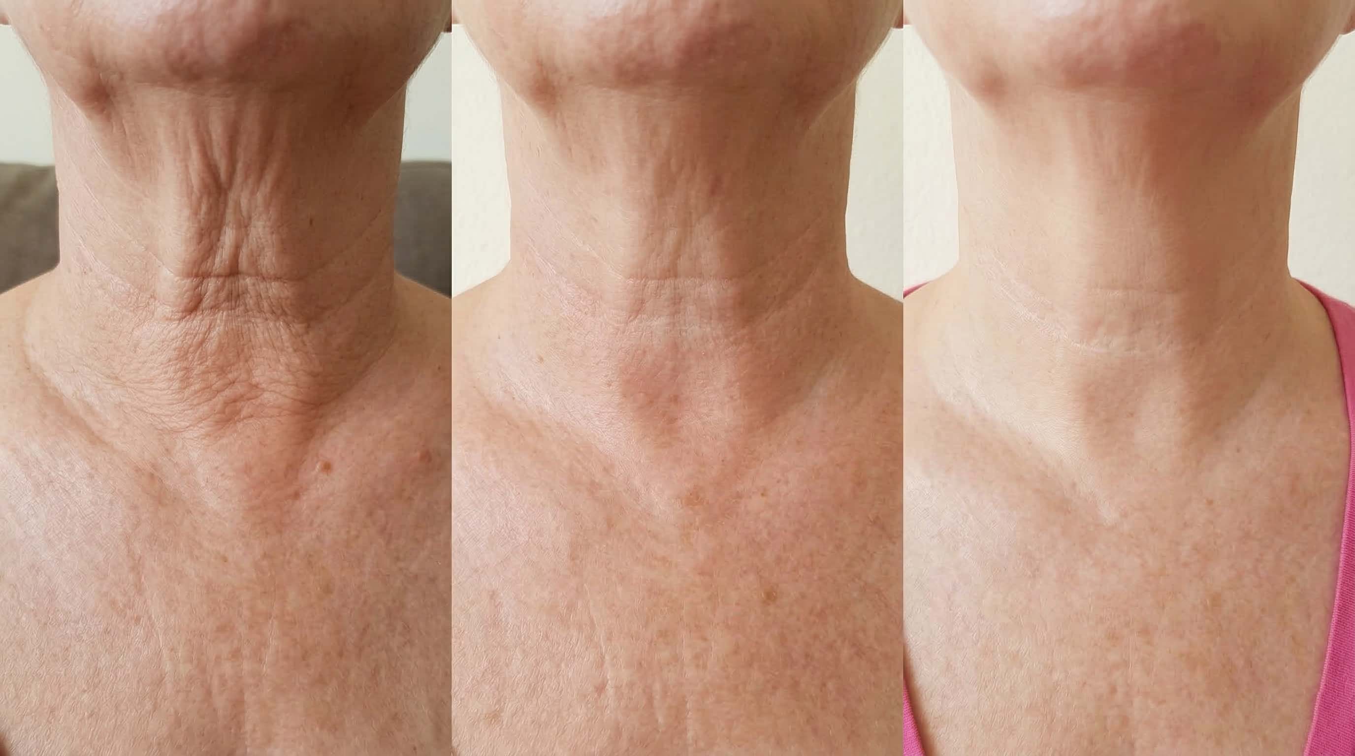 Sichtbare Verbesserung nach vier Wochen