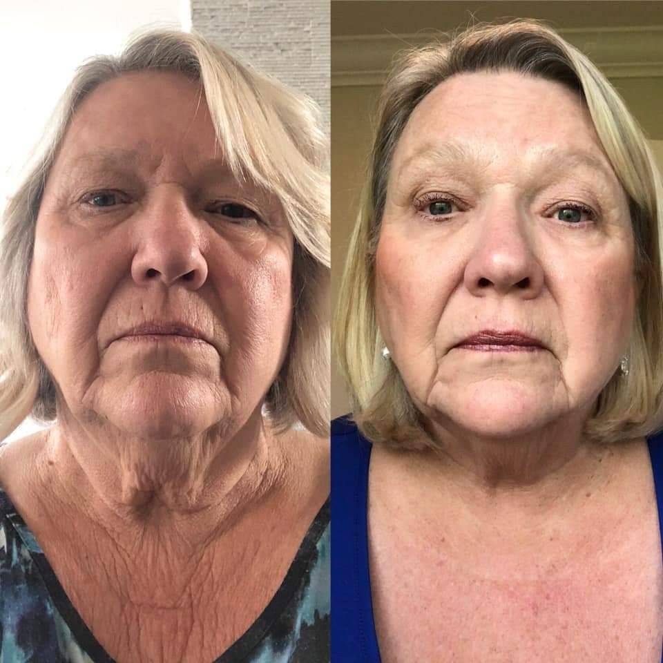 Woman with hair loss