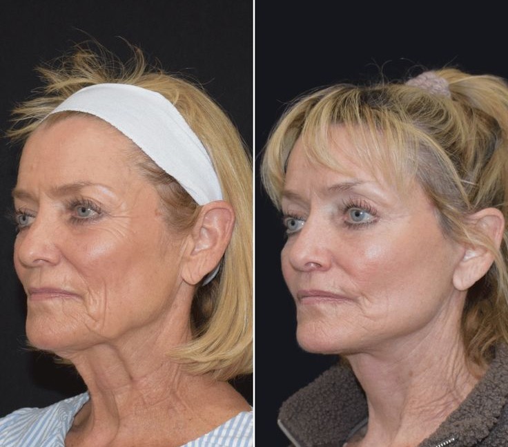 Woman with hair loss