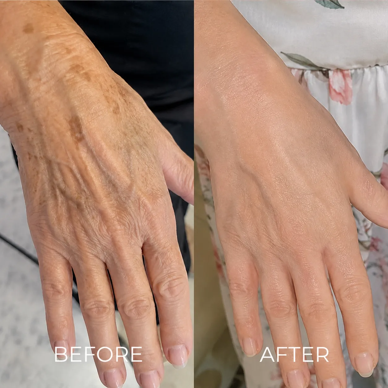 Crepey hands before and after CLEARMADE
