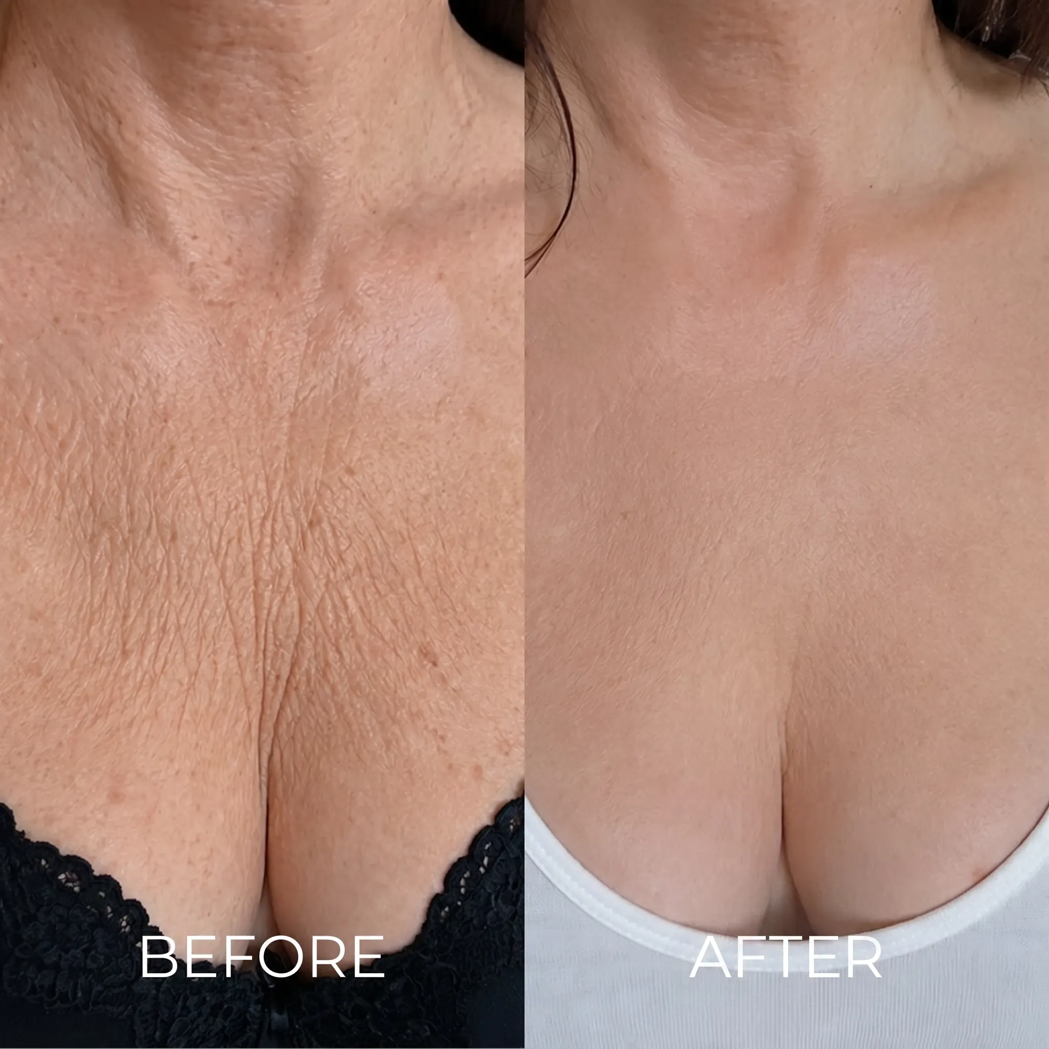 Crinkled chest before and after CLEARMADE