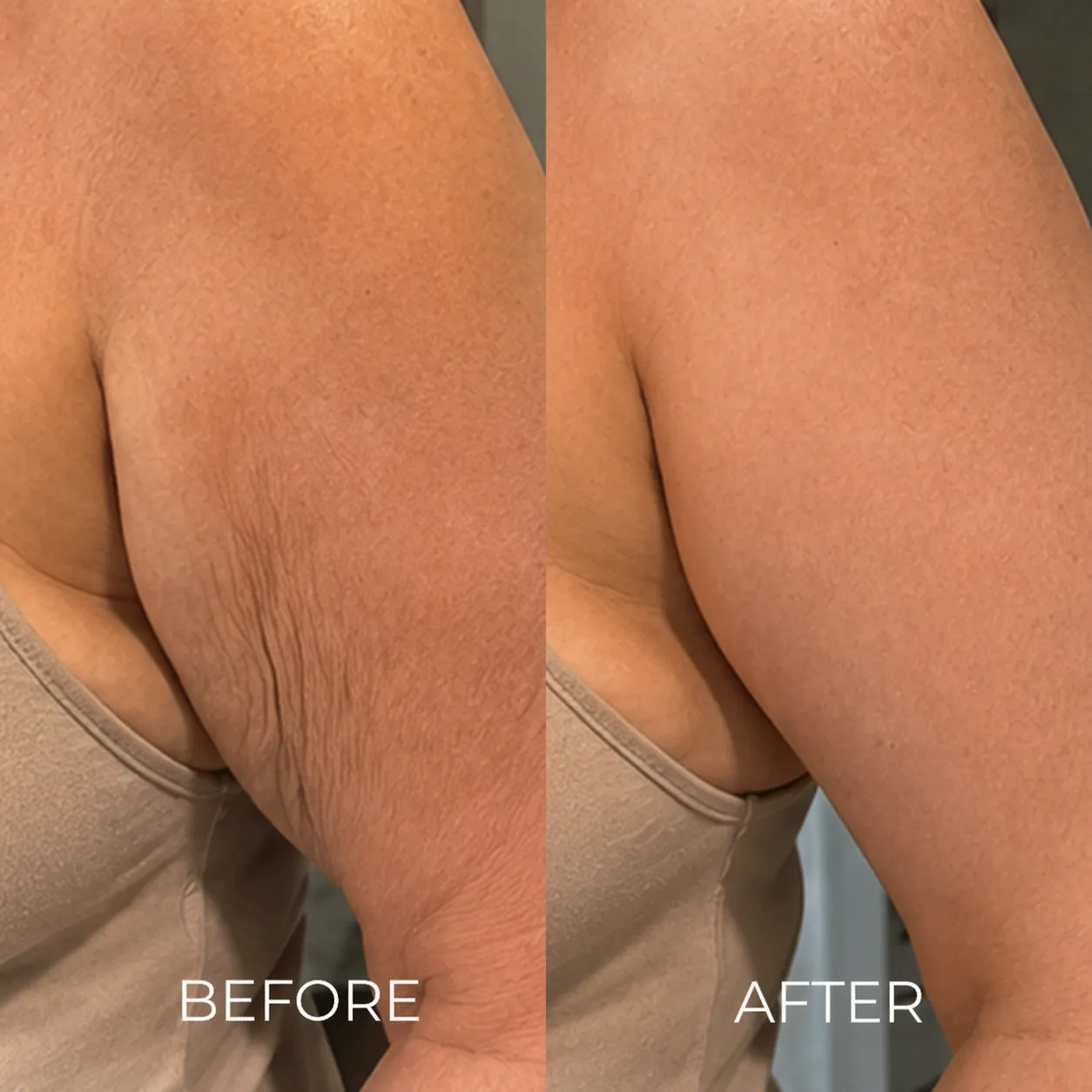 Droopy upper arms before and after CLEARMADE