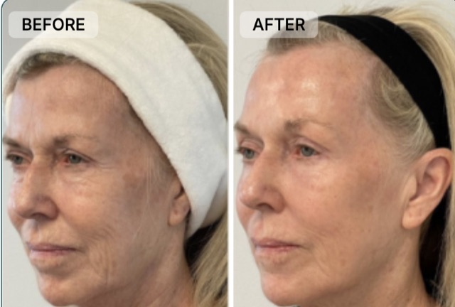 Janet B. before and after with CLEARMADE