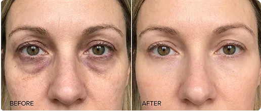 Customer using MyoGlow device