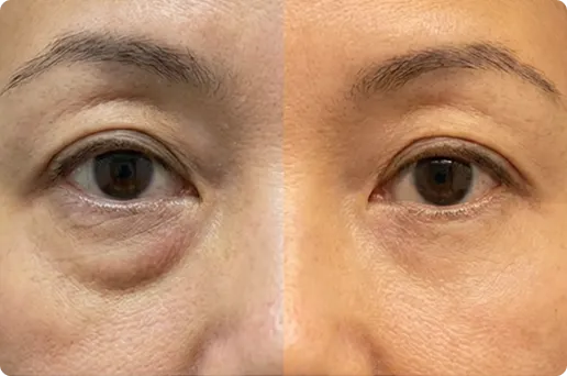 Customer using MyoGlow device