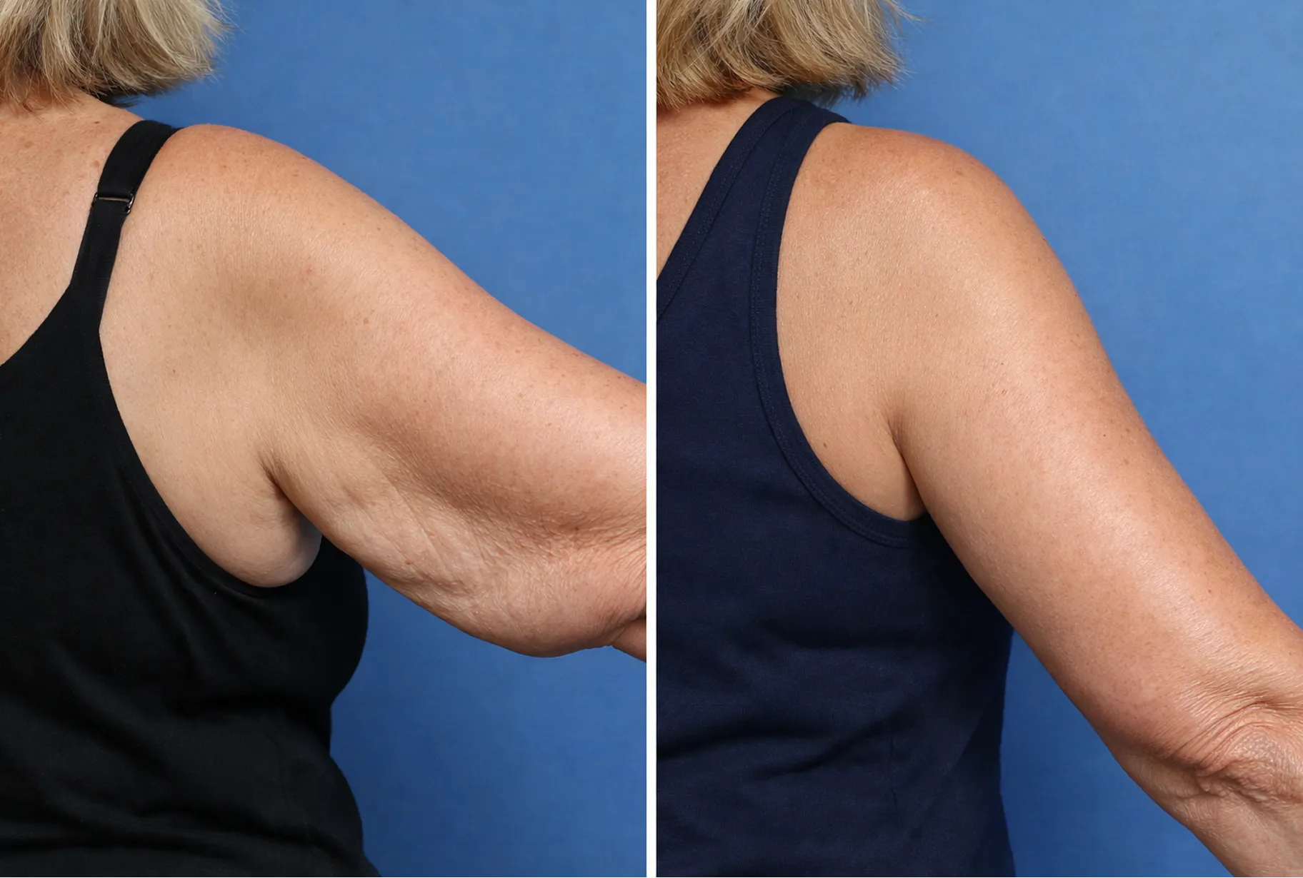 Arm Toning Solutions