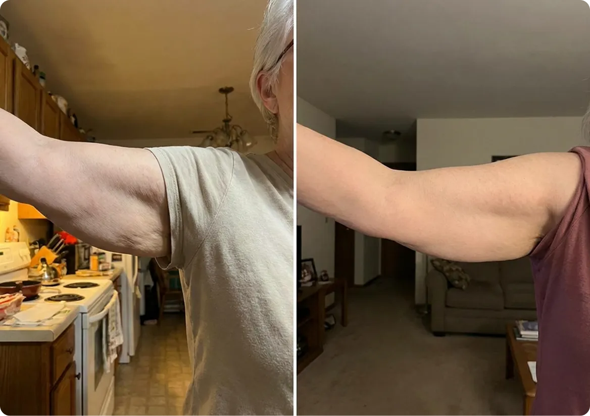 Customer using MyoGlow device