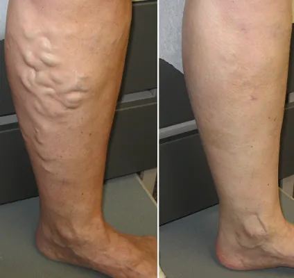 Nurovita® Natural Cooling Roller