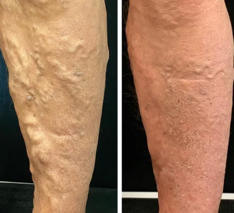 Nurovita® Natural Cooling Roller