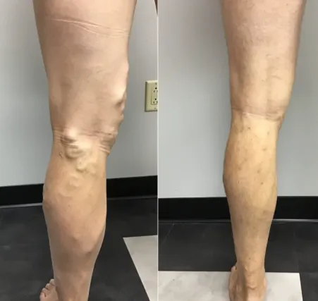 Nurovita® Natural Cooling Roller