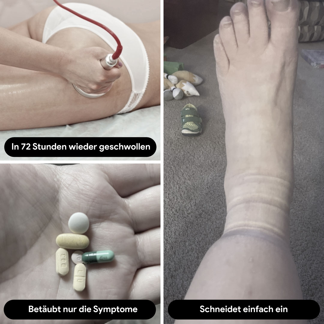 Kompressionsbehandlung bei Lipödem